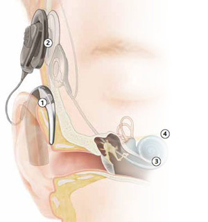 Demonstration of hearing with a cochlear implant