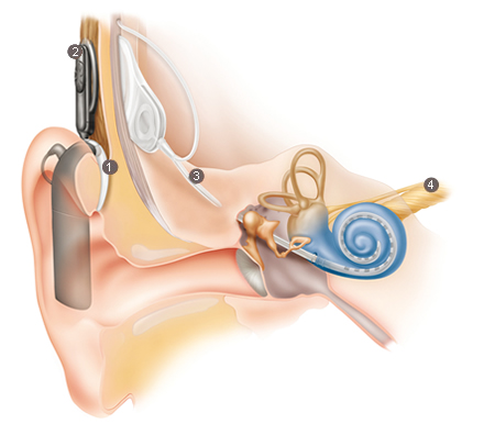 Kết quả hình ảnh cho cochlear implant