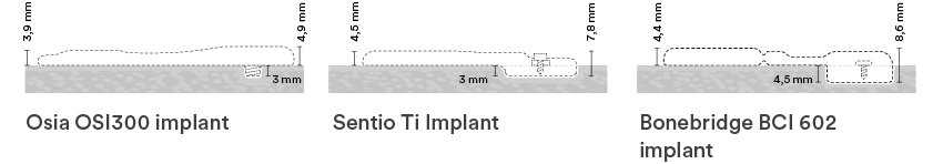 Osia OSI300 implant,Sentio Ti Implant,Bonebridge BCI 602 implan