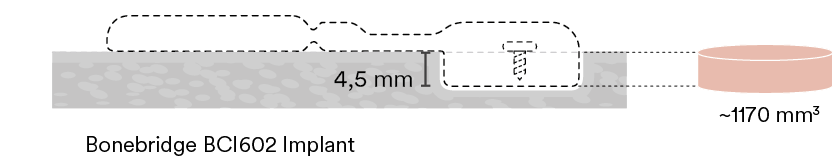 Bonebridge BCI602 Implant,~1170 mm