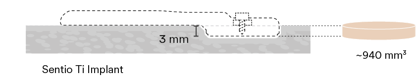 Sentio Ti Implant,~940 mm
