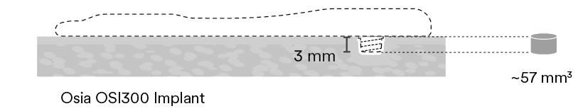 Osia OSI300 Implant,~57 mm