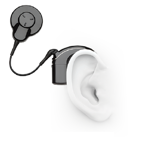 Cochlear implant